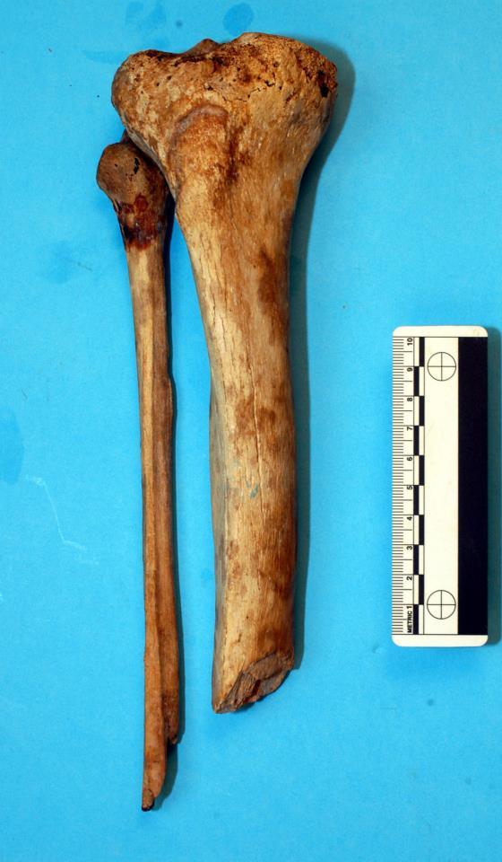 Tibia e Fibula della gamba destra di Giovanni della Bande Nere con i segni della ferita e dell'amputazione subita